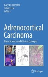 Adrenocortical Carcinoma - 
