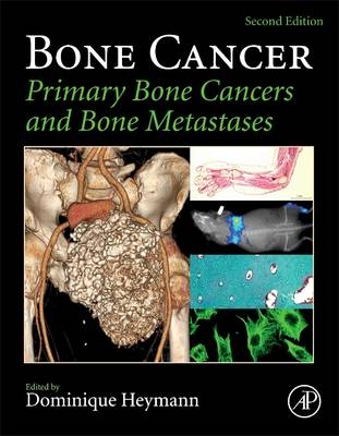 Bone Cancer - 