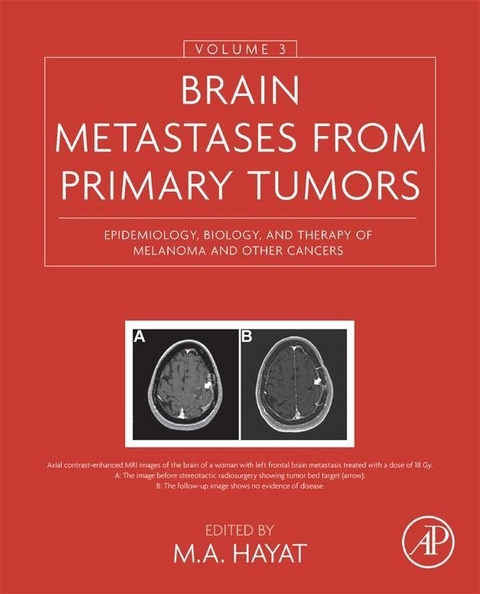 Brain Metastases from Primary Tumors, Volume 3 - 