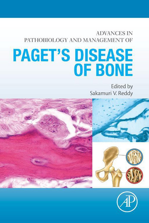 Advances in Pathobiology and Management of Paget's Disease of Bone - 