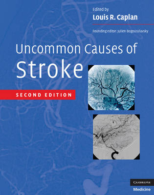 Uncommon Causes of Stroke - 