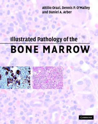 Illustrated Pathology of the Bone Marrow - Attilio Orazi, Dennis P. O'Malley, Daniel A. Arber