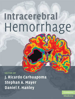 Intracerebral Hemorrhage - 