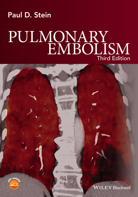 Pulmonary Embolism -  Paul D. Stein