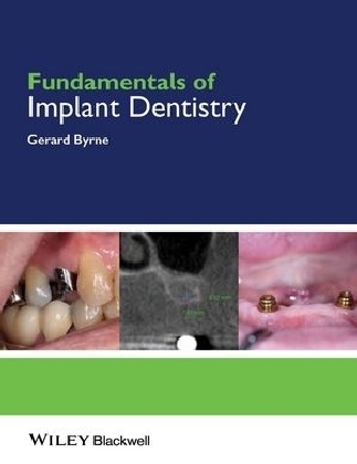 Fundamentals of Implant Dentistry - Gerard Byrne