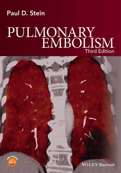 Pulmonary Embolism - Paul D. Stein