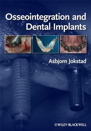 Osseointegration and Dental Implants - 