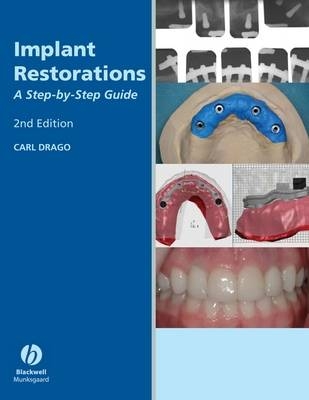 Implant Restorations - Carl Drago, Thomas Peterson