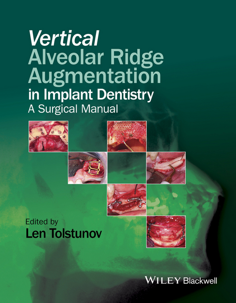 Vertical Alveolar Ridge Augmentation in Implant Dentistry - 