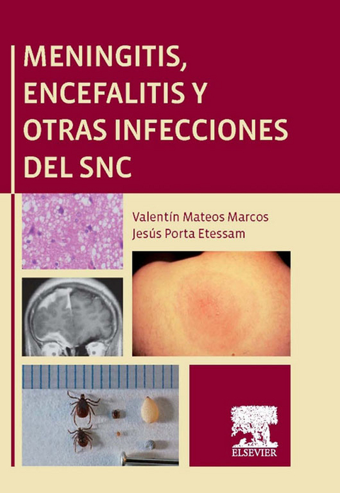 Meningitis, encefalitis y otras infecciones del SNC - 