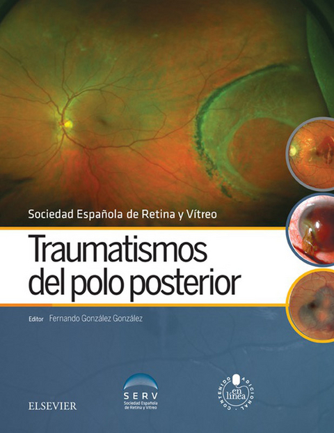 Traumatismos del polo posterior - 