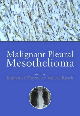 Malignant Pleural Mesothelioma - 