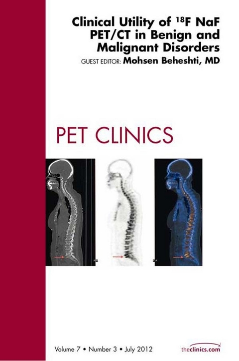 Clinical Utility of 18NaF PET/CT in Benign and Malignant Disorders, An Issue of PET Clinics -  Mohsen Beheshti