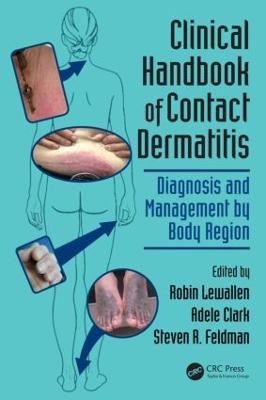 Clinical Handbook of Contact Dermatitis - 