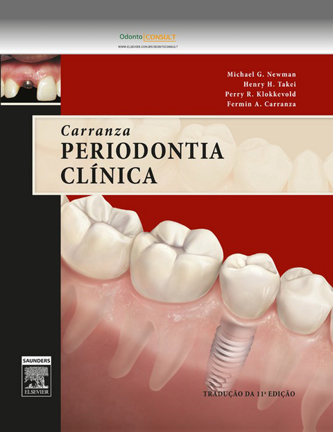 Carranza Periodontia Clínica -  Michael G. Newman,  Henry Takei,  Perry R. Klokkevold,  Fermin A. Carranza