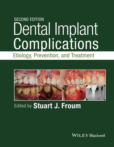 Dental Implant Complications - 