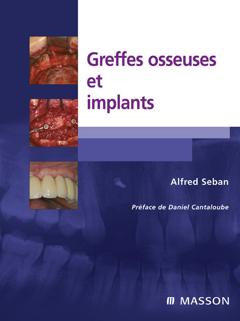 Greffes osseuses et implants -  Alfred Seban