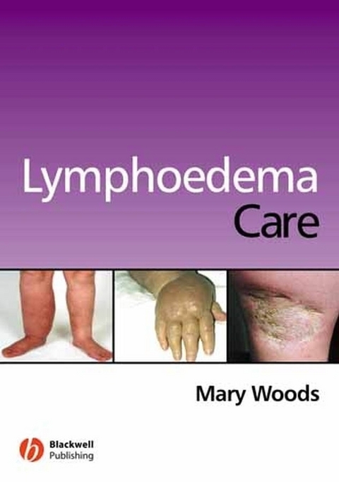 Lymphoedema Care -  Mary Elizabeth Woods
