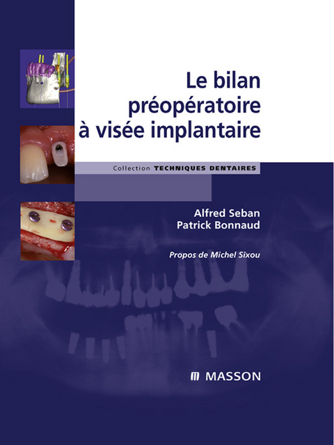 Le bilan préopératoire à visée implantaire -  Patrick Bonnaud,  Alfred Seban