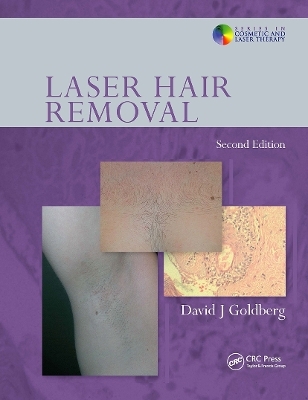 Laser Hair Removal - 