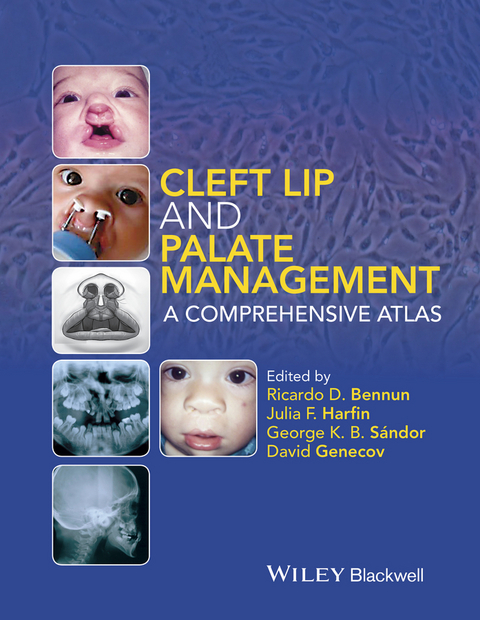 Cleft Lip and Palate Management -  David Genecov,  George K. B. S ndor