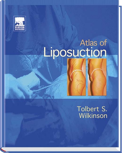 Atlas of Liposuction - Tolbert S. Wilkinson