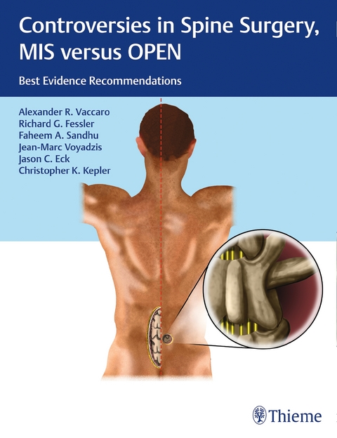 Controversies in Spine Surgery: MIS versus OPEN - 