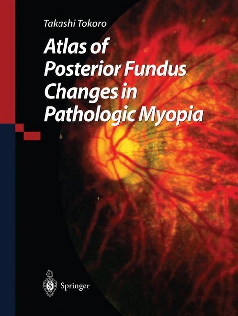 Atlas of Posterior Fundus Changes in Pathologic Myopia -  Takashi Tokoro