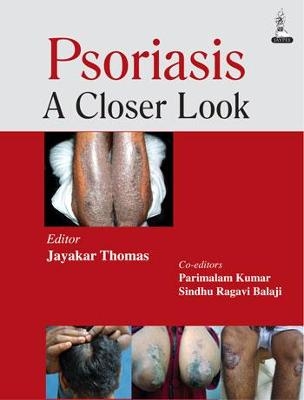 Psoriasis - Jayakar Thomas