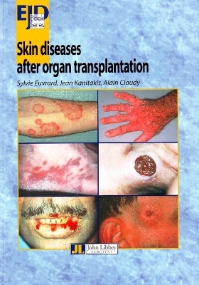 Skin Diseases After Organ Transplantation - Sylvie Euvrard, Jean Kanitakis, Alain Claudy