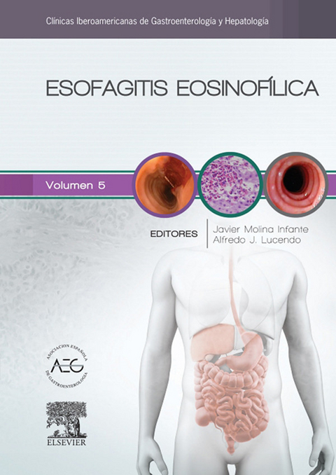 Esofagitis eosinofílica - 