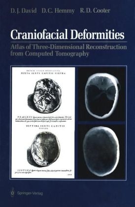 Craniofacial Deformities - David J David, David C Hemmy, Rodney D Cooter