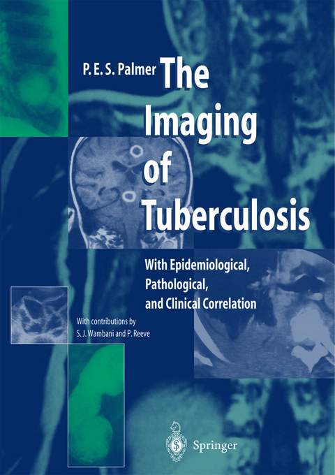 The Imaging of Tuberculosis - P.E.S. Palmer