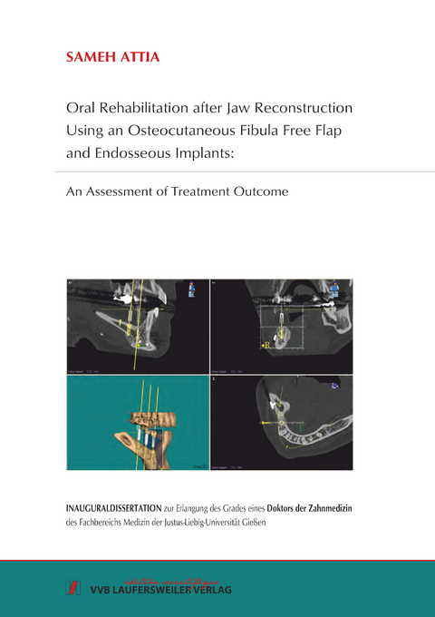 Oral rehabilitation after jaw reconstruction using an osteocutaneous fibula free flap and endosseous implants: An Assessment of Treatment Outcome - Sameh Attia