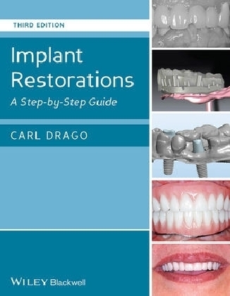 Implant Restorations - Carl Drago