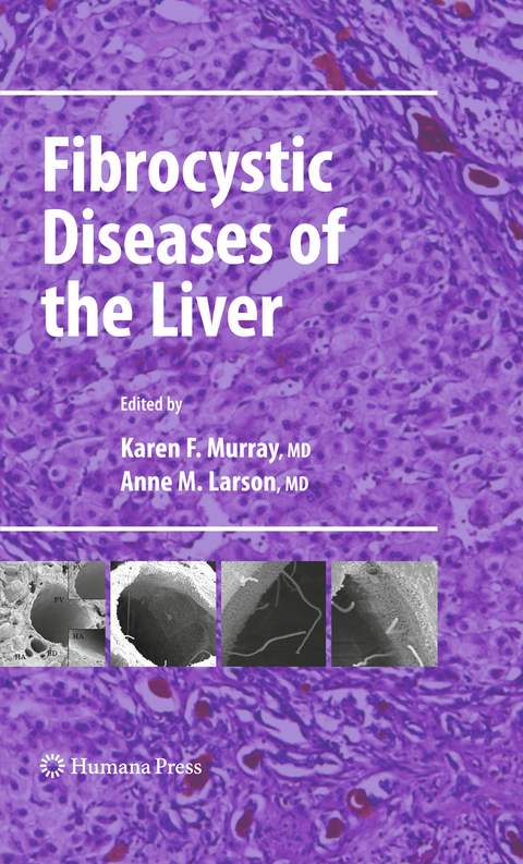 Fibrocystic Diseases of the Liver - 