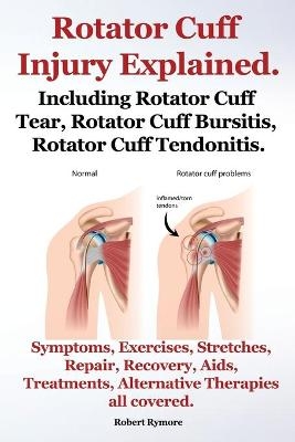 Rotator Cuff Injury Explained. Including Rotator Cuff Tear, Rotator Cuff Bursitis, Rotator Cuff Tendonitis. Symptoms, Exercises, Stretches, Repair, Recovery, Aids, Treatments, Alternative Therapies all covered. - Robert Rymore