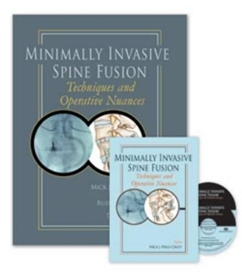 Minimally Invasive Spine Fusion - 