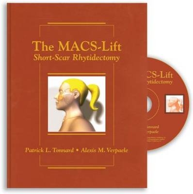 The Macs-Lift Short Scar Rhytidectomy - Patrick L Tonnard
