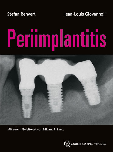 Periimplantitis - Stefan Renvert, Jean-Louis Giovannoli