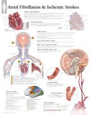 Atrial Fib & Ischemic Strokes Paper Poster -  Scientific Publishing