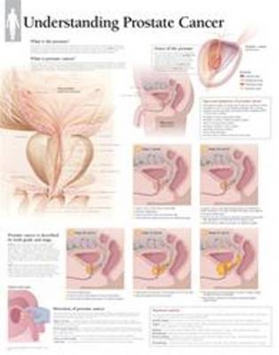 Understanding Prostate Cancer Laminated Poster -  Scientific Publishing