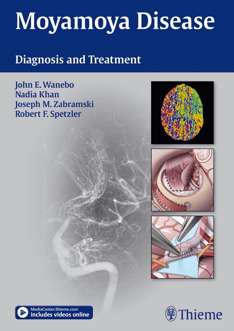 Moyamoya Disease - 