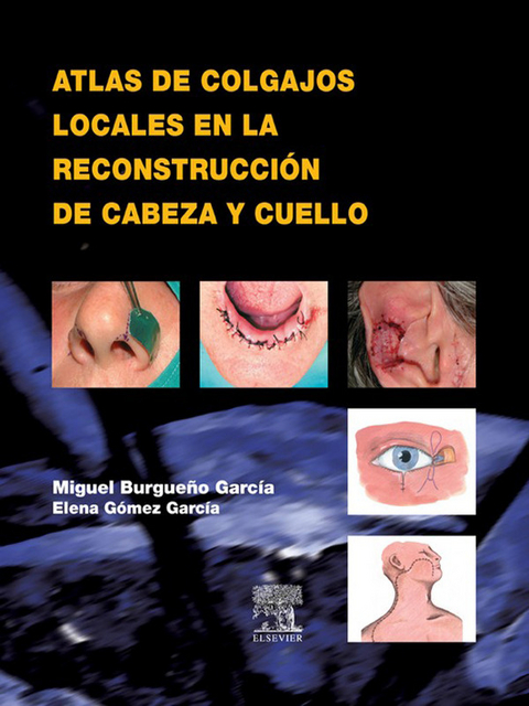 Atlas de Colgajos Locales en la Reconstruccion de Cabeza y Cuello -  Miguel Burgueno