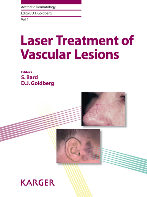 Laser Treatment of Vascular Lesions - 