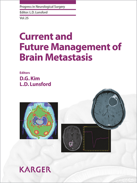 Current and Future Management of Brain Metastasis - 