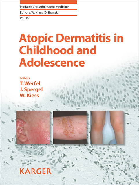 Atopic Dermatitis in Childhood and Adolescence - 