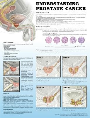Understanding Prostate Cancer 2e Paper -  Anatomical Chart Company, James Gulley