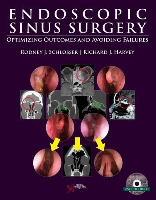Endoscopic Sinus Surgery - 