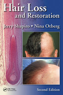 Hair Loss and Restoration, Second Edition - 